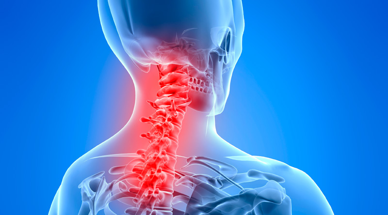 Cervicalgia: cause, sintomi e come curarla
